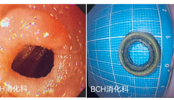 坚果、回形针、木棍！孩子你还有什么不敢吞的？